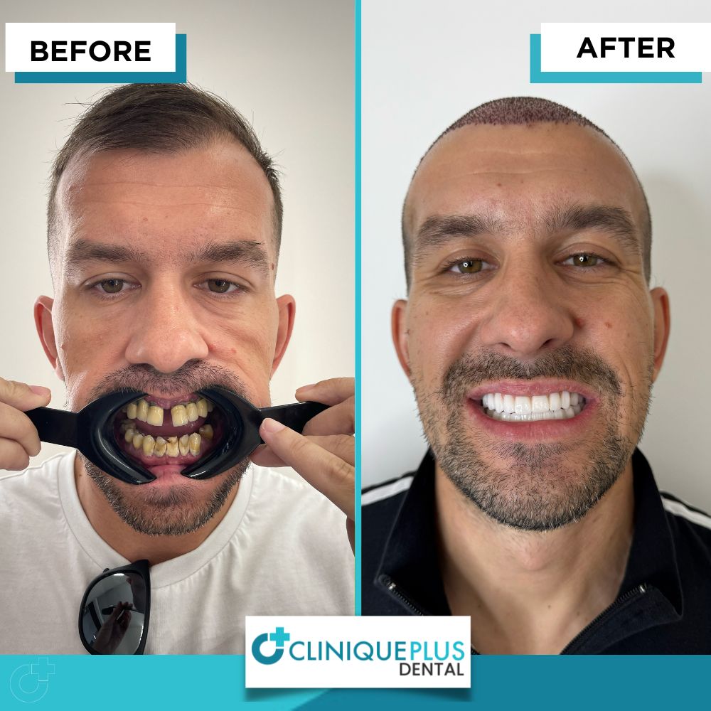 All-on-6 dental implants Turkey before and after - Denis Stojanovic from the USA, full mouth All-on-Six smile makeover at CLINIQUEPLUS Istanbul