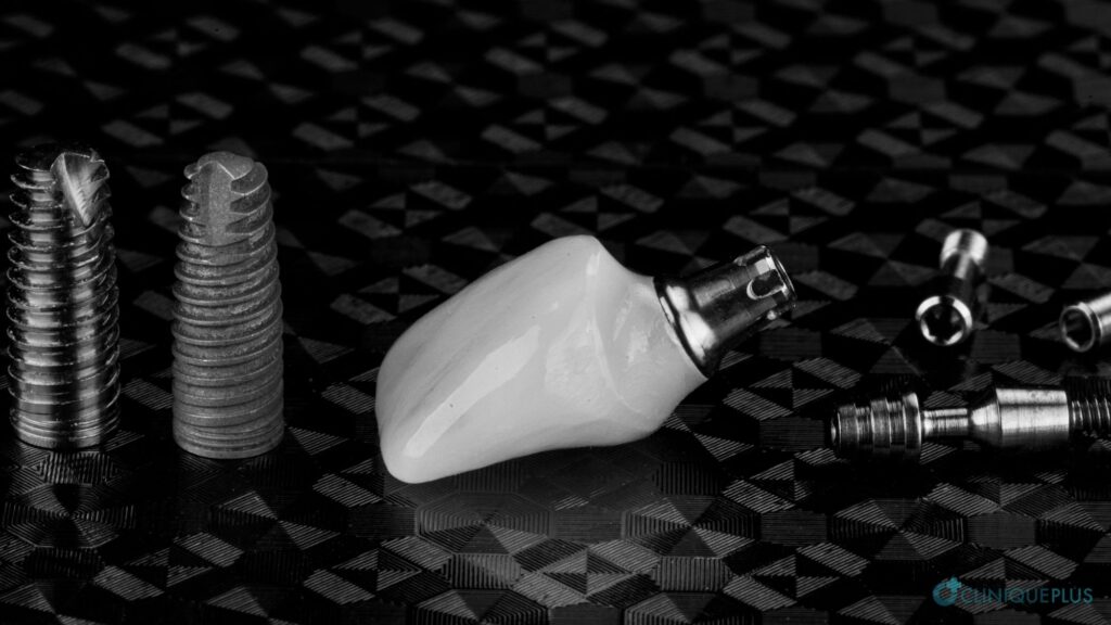 Top Implant Brands: A Comprehensive Guide - CLINIQUEPLUS