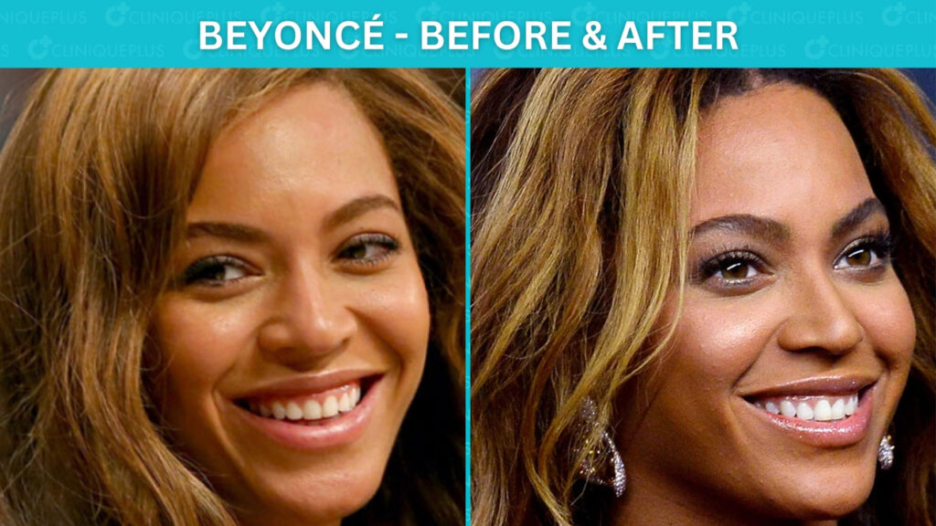 Famous Celebrity Veneers Before and After: Hollywood Smile ...