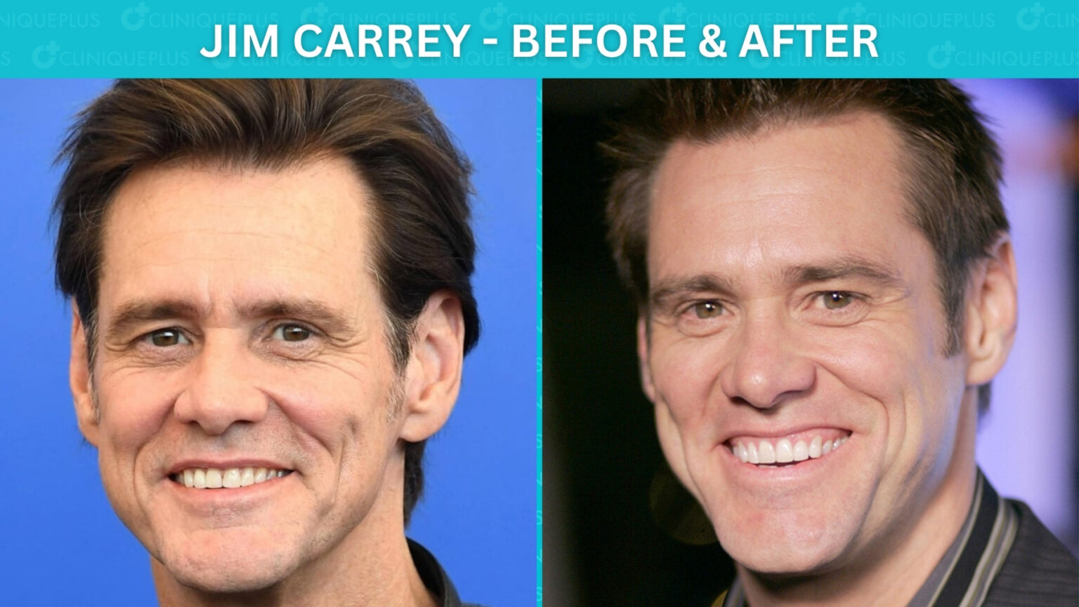 Famous Celebrity Veneers Before and After: Hollywood Smile