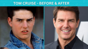 Famous Celebrity Veneers Before and After: Hollywood Smile
