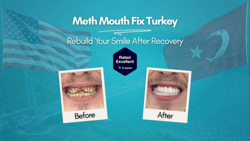 Meth mouth before and after treatment in Turkey — severe dental decay restored with full mouth reconstruction at CLINIQUEPLUS Istanbul