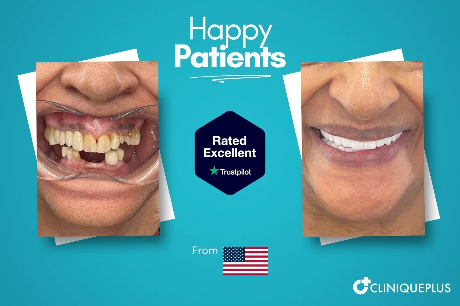 Full mouth reconstruction before and after Istanbul — missing teeth and gum damage restored with full arch implants at CLINIQUEPLUS Turkey, US patient