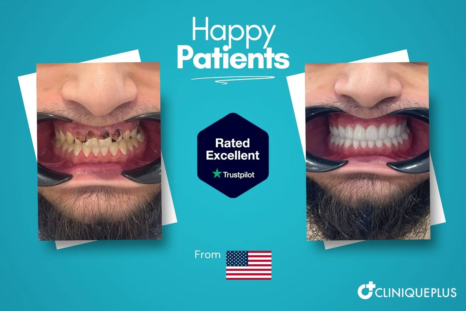 Before and after full mouth reconstruction Turkey — decayed and missing upper teeth rebuilt with zirconia implant arch at CLINIQUEPLUS Istanbul, US patient