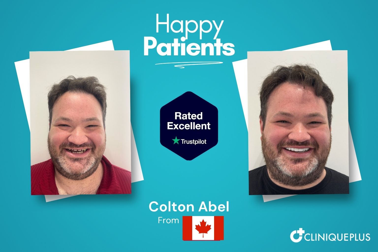 Colton Abel from the Canada — before and after dental implants Turkey at CLINIQUEPLUS Istanbul, affordable premium quality treatment, rated Excellent on Trustpilot