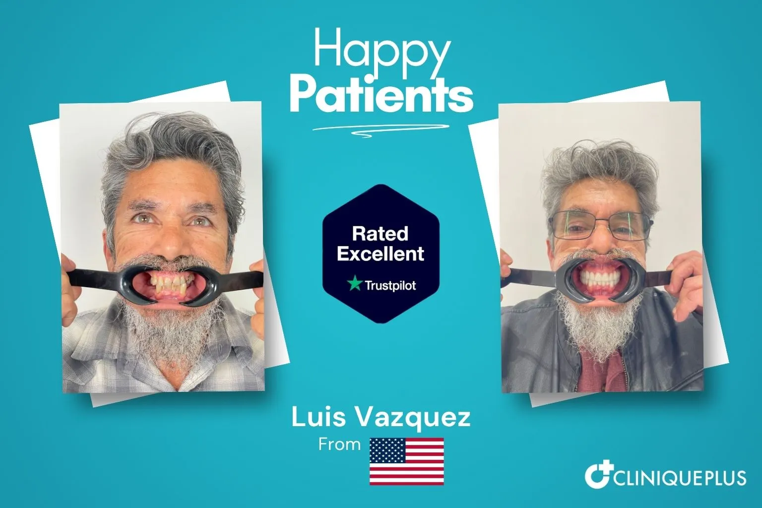Luis Vazquez from the USA — before and after full arch dental implants Turkey at CLINIQUEPLUS Istanbul, near-complete tooth loss restored affordably