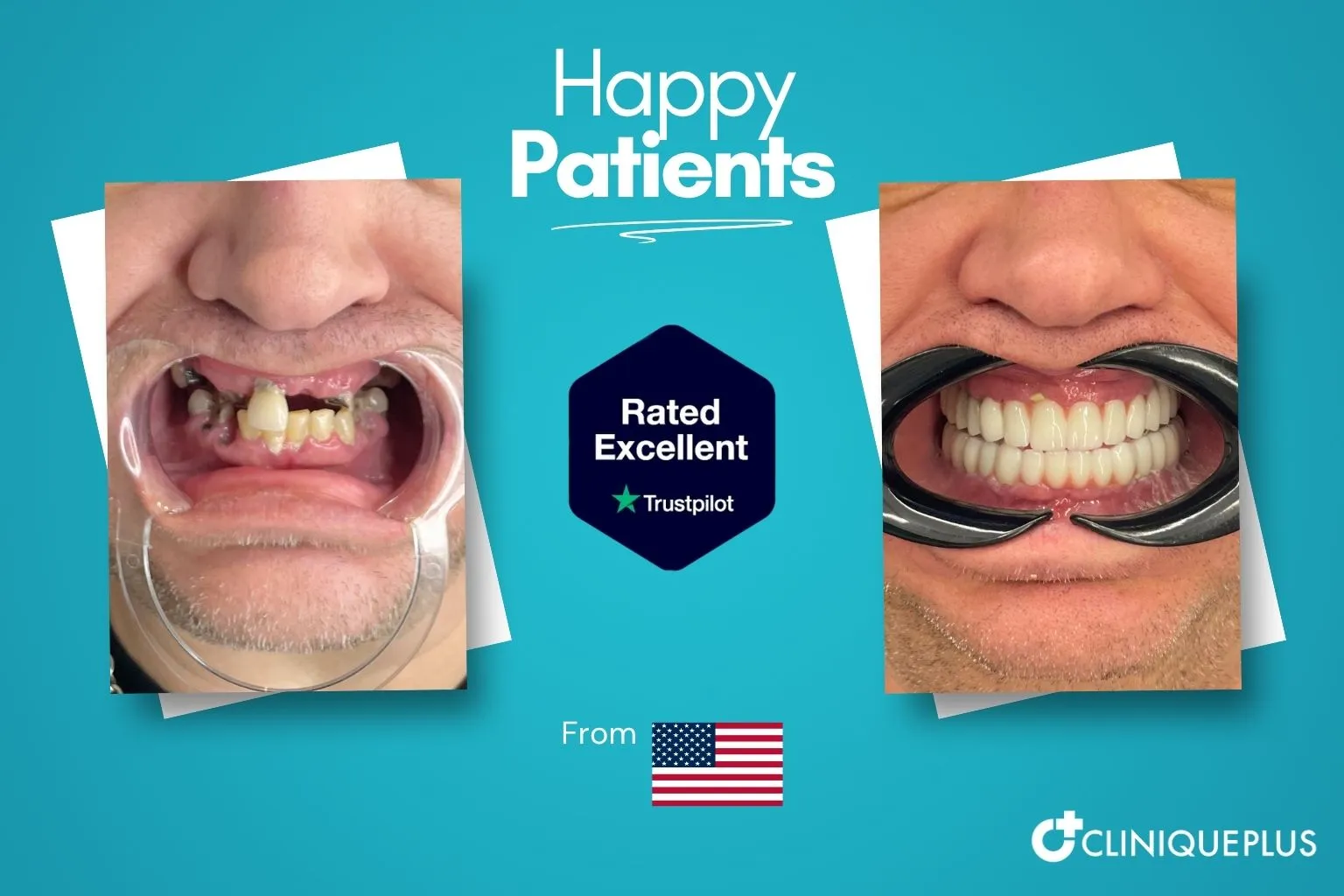 Meth mouth repair before and after Turkey — severe tooth loss rebuilt with full arch implants at CLINIQUEPLUS Istanbul, US patient