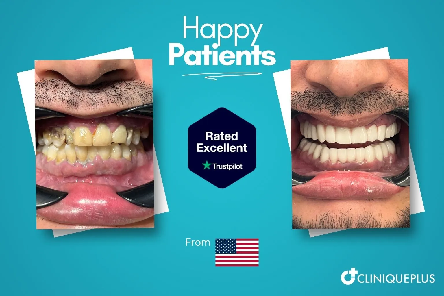 Meth mouth repair cost Turkey before and after — yellowed decayed teeth replaced with full zirconia arch at CLINIQUEPLUS Istanbul, US patient