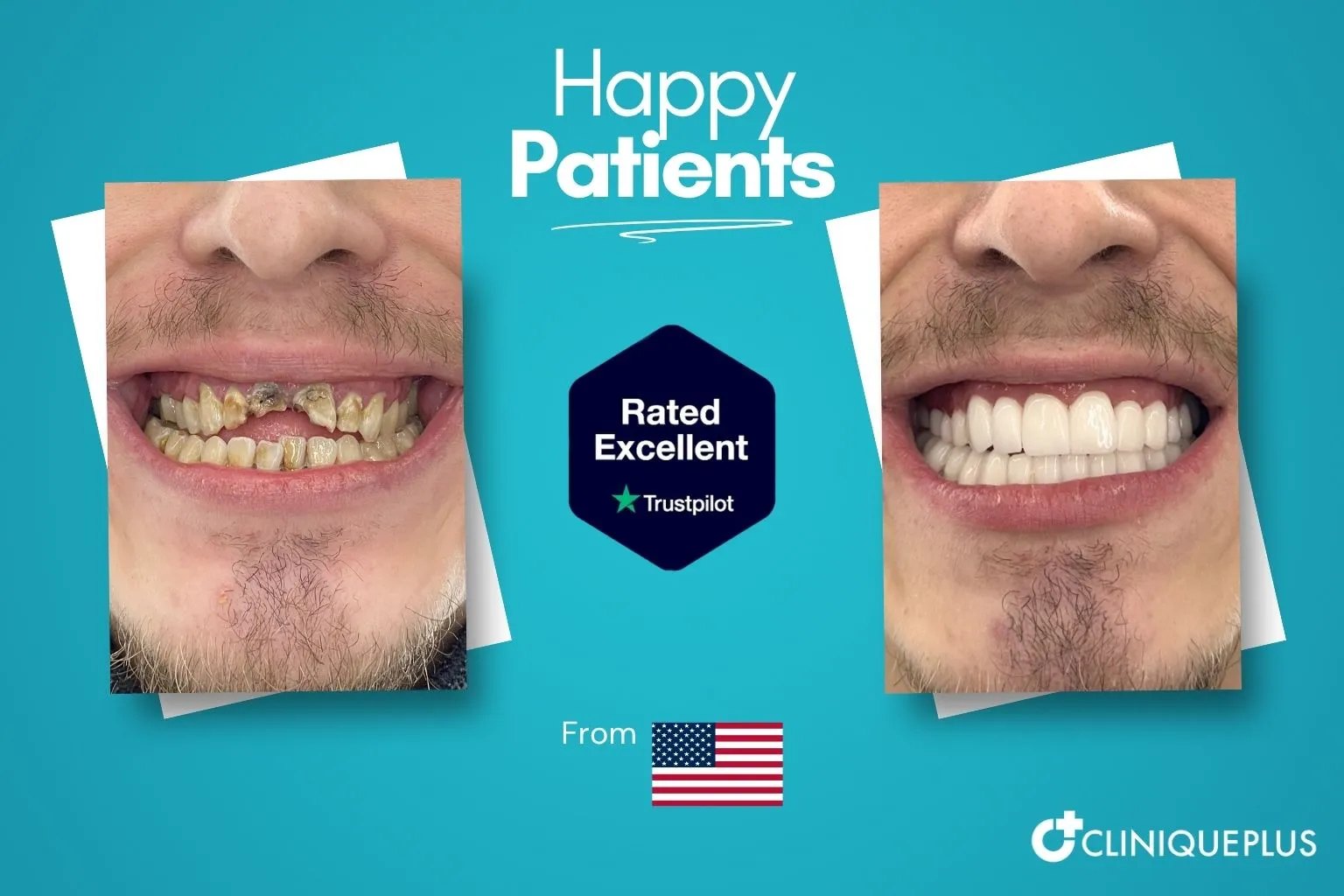 Before and after meth mouth repair Turkey — decay and missing teeth restored with implant reconstruction at CLINIQUEPLUS Istanbul, US patient
