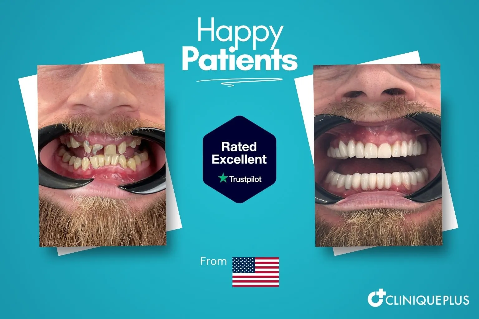Meth mouth repair before and after Istanbul — near-complete tooth loss from addiction rebuilt with full arch implants at CLINIQUEPLUS Turkey