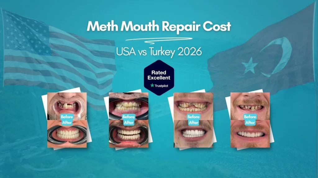Meth mouth repair cost USA vs Turkey 2026 — four before and after results at CLINIQUEPLUS Istanbul, rated Excellent on Trustpilot